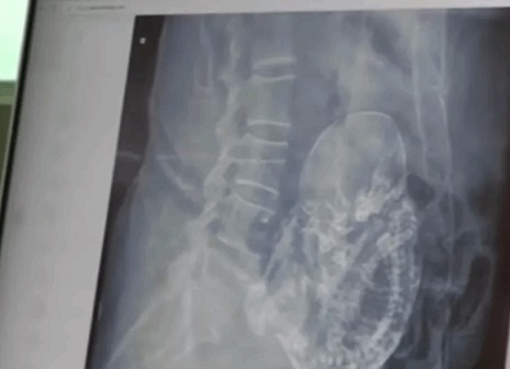 صورة أشعة للجنين المتحجر في رحم أمه منذ 40 عاماً